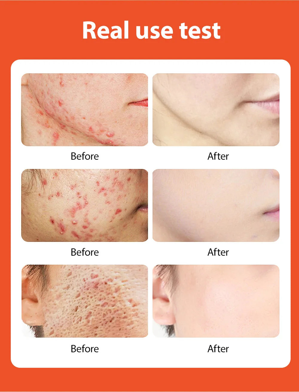 Clear Skin Salicylic Acid Treatment Cream